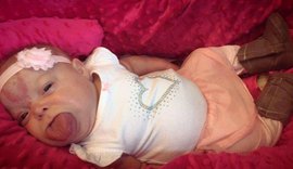 Após cirurgias, bebê que nasceu com língua gigante sorri pela 1ª vez