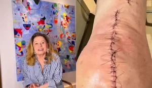 Atriz Vera Fischer passa por cirurgia delicada e faz revelação
