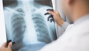 Anvisa aprova novo medicamento para câncer de pulmão avançado