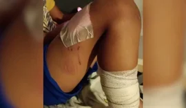 Crianças ficam feridas após ataque de pitbull em condomínio de Monte Mor