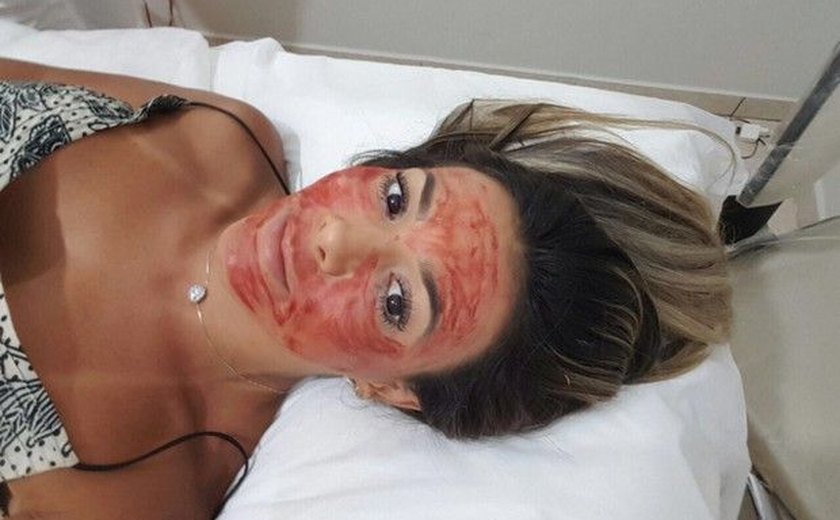 Ex-BBB Fabiana Teixeira faz tratamento com sangue no rosto