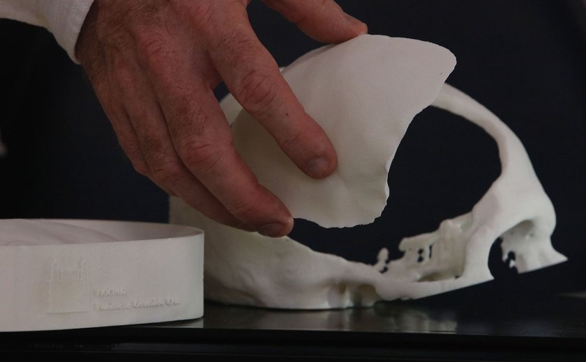 Pesquisadores brasileiros desenvolvem tecnologia de reconstrução craniana