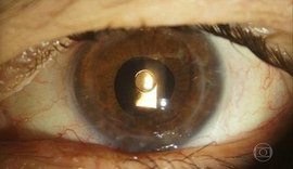 Oftalmologista brasileiro desenvolve lente que evita transplante de córnea