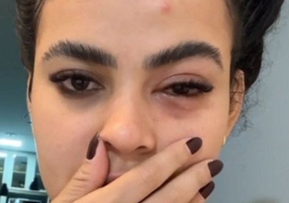 Mulher tem infecção no olho causada por mosca de banheiro