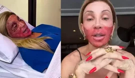 Maya Massafera deixa rosto em carne viva e motivo vem à tona