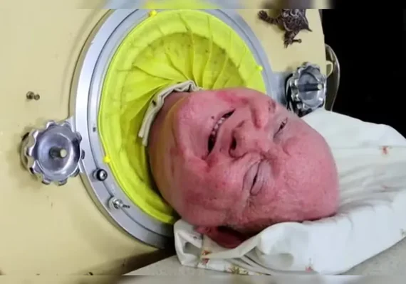 Morre homem que viveu 70 anos em 'pulmão de ferro'