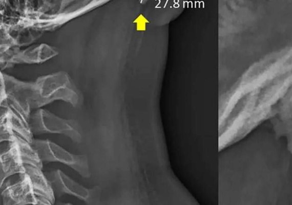 Cientistas descobrem 'chifre' crescendo no crânio de jovens por uso em excesso de celular