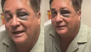 Cantor Leonardo surge de olho roxo após acidente e esposa relata susto em passeio