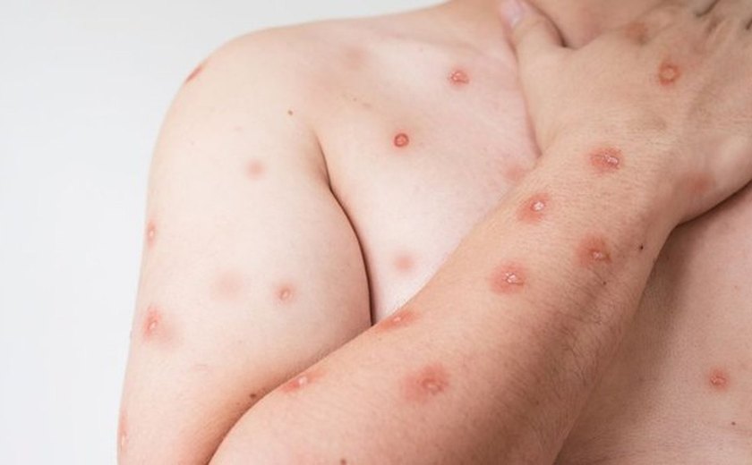 Sobe para 140 número de casos confirmados de Mpox no país