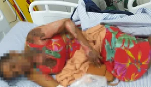 Mulher sofre queimaduras graves em várias partes do corpo em tentativa de feminicídio