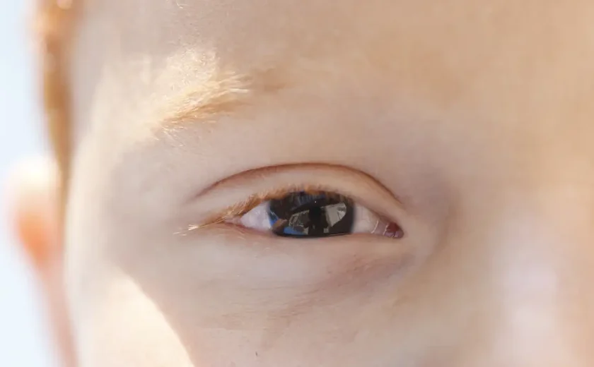 Erros de refração são principal causa de deficiência visual infantil