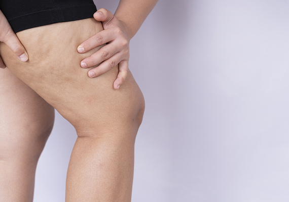Lipedema ganha visibilidade durante o Junho Roxo e alerta para a importância do diagnóstico