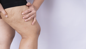 Lipedema ganha visibilidade durante o Junho Roxo e alerta para a importância do diagnóstico