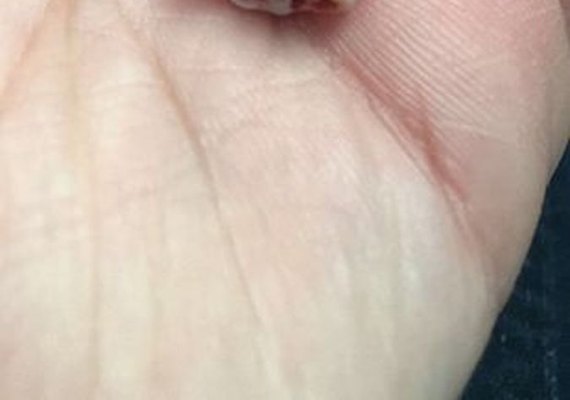 Dente 'amortece' bala e salva turista atingido por tiro na nuca em assalto