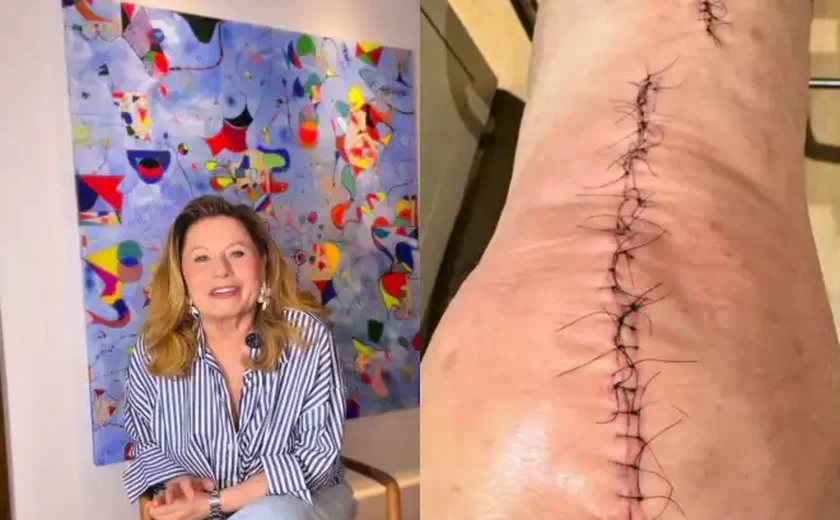 Atriz Vera Fischer passa por cirurgia delicada e faz revelação