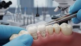 Adeus às dentaduras: adesivo promete fazer dentes renascerem