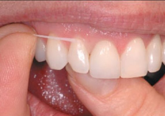 Fio dental é a recomendação para uma higiene completa