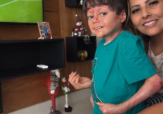 Quem é Gui, torcedor vascaíno vencedor de prêmio da Fifa, que sofre de epidermólise bolhosa