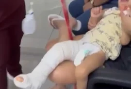 Criança de dois anos recebe alta após fratura no fêmur e família denuncia falha em atendimento médico