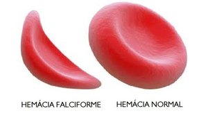 Ministério da Saúde amplia faixa etária de transplante para doença falciforme