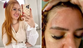 Empresária tem queimadura grave após panela de pressão explodir