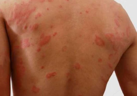 Saúde reforça alerta sobre sinais e sintomas da Hanseníase