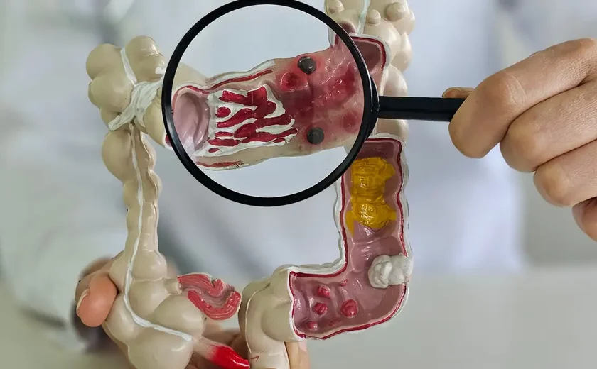 Em 13 anos, doença inflamatória intestinal cresce 5 vezes no Brasil