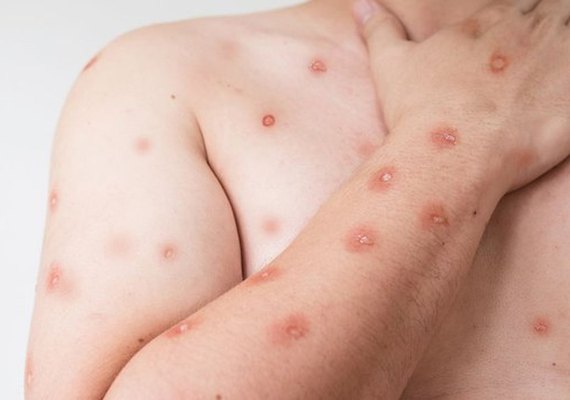 Sobe para 140 número de casos confirmados de Mpox no país