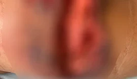 Ambiente insalubre e improvisado: dentista aplicava silicone industrial em casas de pacientes