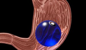 As 6 principais dúvidas sobre o balão intragástrico