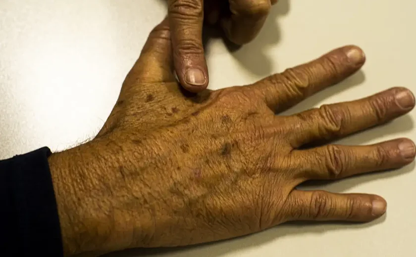 Desinformação sobre câncer de pele afeta diagnóstico, diz instituição