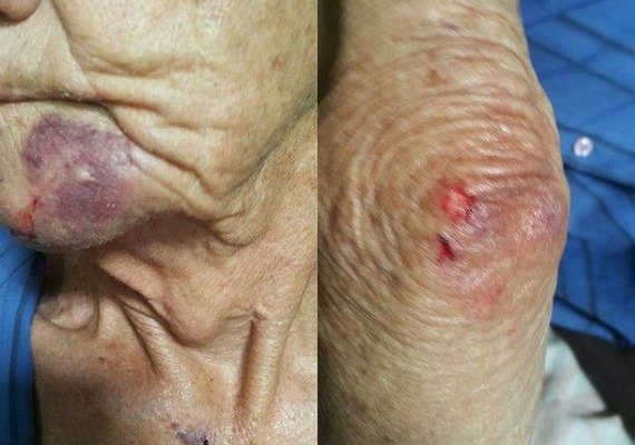 Idoso espancado por bandidos ao ir comprar pão não quer sair mais na rua