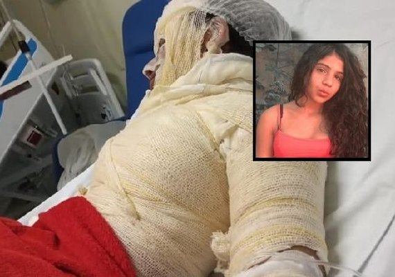 Adolescente sofre queimaduras de 2º grau em acidente com álcool em gel