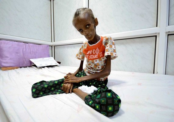 Unicef: uma criança morre a cada 10 minutos no Iêmen por desnutrição