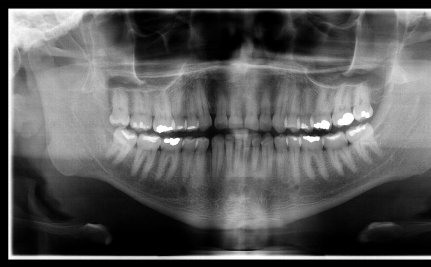 Corpo de enfermeiro do Mato Grosso é identificado pelo IML após exame de odontologia legal