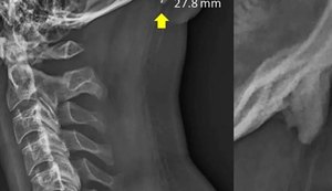 Cientistas descobrem 'chifre' crescendo no crânio de jovens por uso em excesso de celular