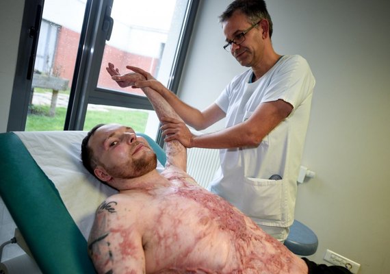 Homem de 33 anos sobrevive na França graças a transplante de pele do irmão gêmeo