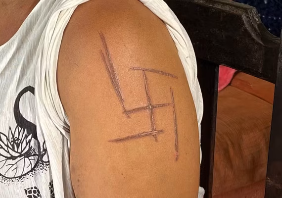 'Tenho que trocar a minha pele', diz mulher trans marcada com símbolo nazista durante tortura em MS