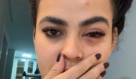Mulher tem infecção no olho causada por mosca de banheiro
