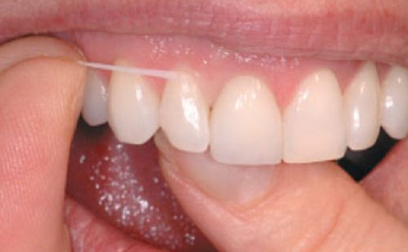 Fio dental é a recomendação para uma higiene completa