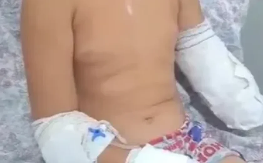 Criança de 10 anos  perde parte do braço após grave colisão entre ambulância e ônibus em Maribondo