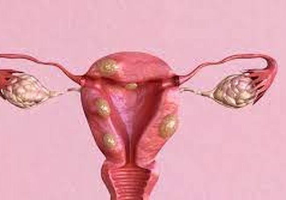 Estudo mostra que 80% das mulheres com idade fértil possuem miomas uterinos