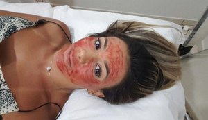 Ex-BBB Fabiana Teixeira faz tratamento com sangue no rosto