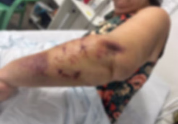 Turista de 70 anos é atacada por três cães e sofre ferimentos graves em Paripueira