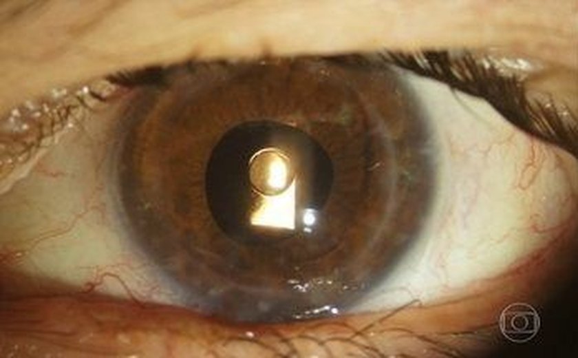 Oftalmologista brasileiro desenvolve lente que evita transplante de córnea