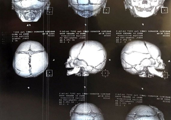 Após pai ser preso, mãe também é detida por suspeita de agredir bebê de seis meses