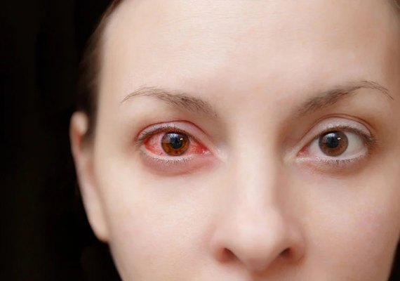 Conjuntivite: oftalmologista orienta sobre prevenção e quando buscar atendimento