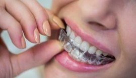 Sorrir virou tendência: mercado de ortodontia estética vive seu melhor momento