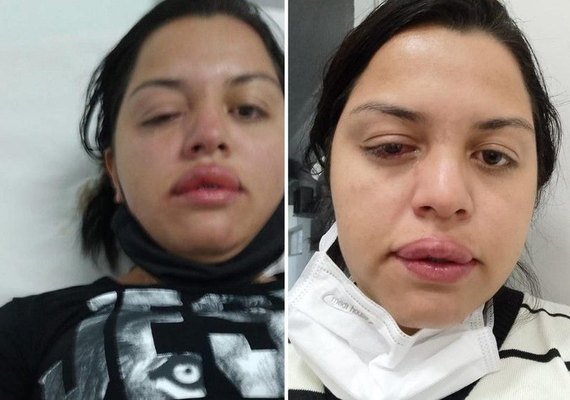 Faxineira atacada pelo ex-patrão com ácido teme perder visão de um olho