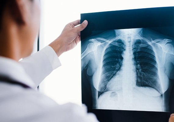 Saiba mais sobre a Fibrose Cística: condição genética que afeta pulmões e sistema digestivo